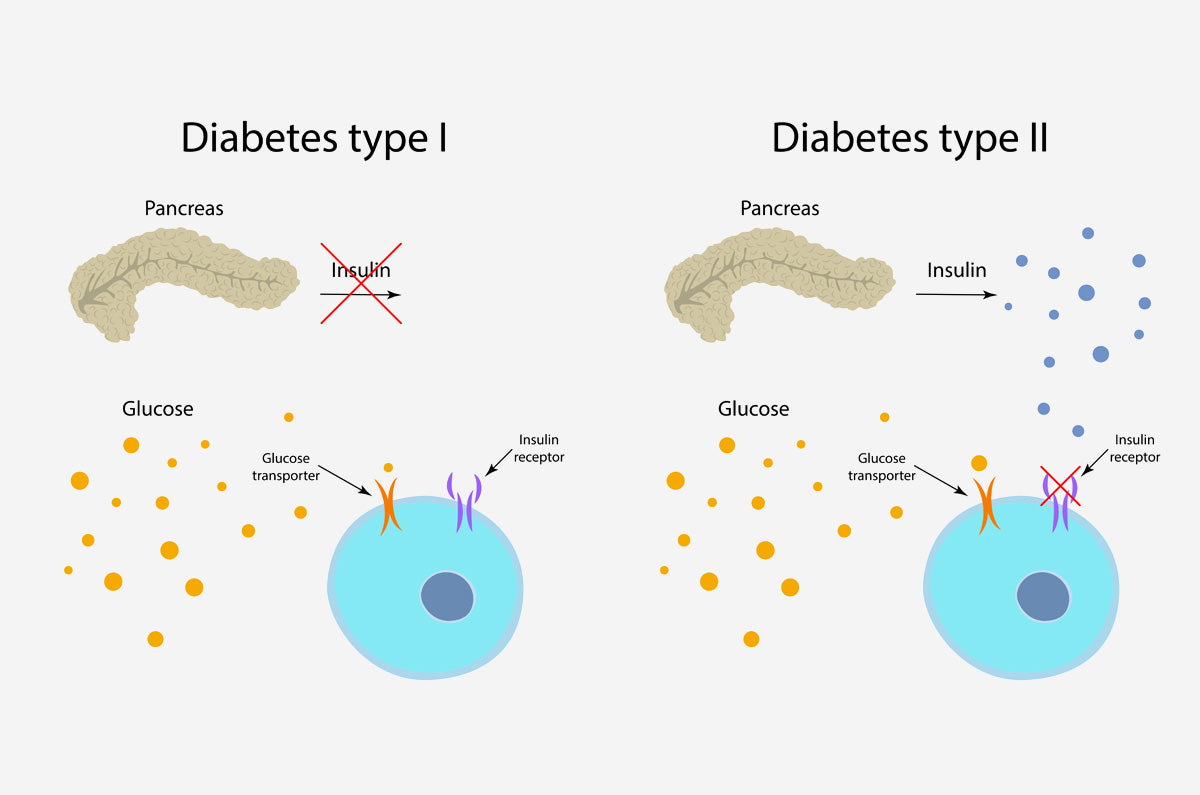The difference between type 1 and type 2 diabetes.
